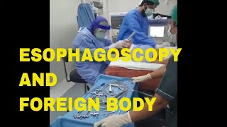 Covid and Esophagoscopy  Endoscopy and Foreign Body removal  Dr Sultan Badar Munir  Endoscopy [upl. by Ttezzil]