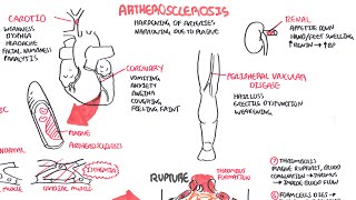 Atherosclerosis  Pathophysiology [upl. by Marybelle]