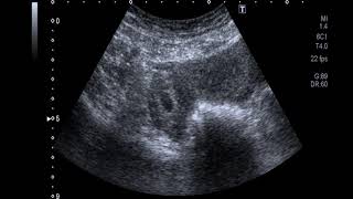 GH Ectopic Pregnancy with CRL FCA ve in Right Adnexa [upl. by Girvin838]