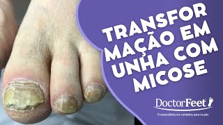 OVERGROWN INFECTED INGROWN TOENAIL REMOVAL PODOLOGIA EM UNHA ENCRAVADA [upl. by Lachance]