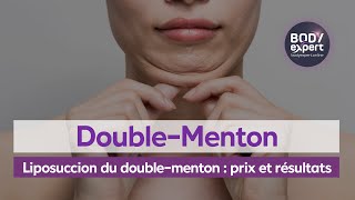 CHIRURGIE ESTHÉTIQUE  🙋🏻‍♀️Liposuccion du doublementon  prix et résultats  BODYEXPERT [upl. by Rimola]