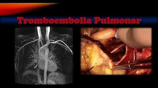 Tromboembolia pulmonar [upl. by Bjork519]