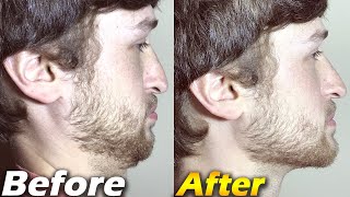 Crazy Jawline Transformation BEFORE and AFTER  Jawline Exercises [upl. by Franci]