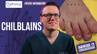 How To Get Rid Of CHILBLAINS Pernio Itchy Sores On Your Fingers And Toes  Doctor Explains [upl. by Ebneter620]