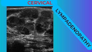 Cervical lymphadenopathy conglomerating nodes on ultrasound scan [upl. by Nylteak]