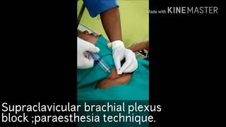 Supraclavicular plexus blockparaesthesia technique [upl. by Nirra]