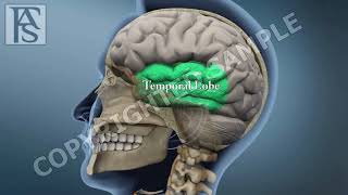 Diffuse Axonal Brain Injury [upl. by Granny]