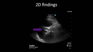 PointofCare Echo Aortic Stenosis vs Sclerosis [upl. by Trilley]