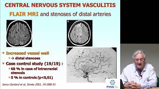 Vascularite cérébralevascularite du système nerveux central 1ère partie [upl. by Haramat760]