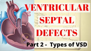 VENTRICULAR SEPTAL DEFECTS PART 2 Types of VSD [upl. by Lama762]