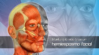 Hemiespasmo Facial Clínica Las Condes [upl. by Nesline]