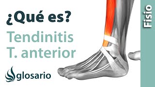 TENDINITIS DEL TIBIAL ANTERIOR  ¿Qué es [upl. by Neltiac]