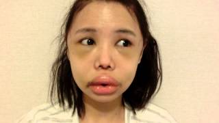 REGEN and Me Part 2 of my Vline Zygoma Reduction Paranasal Implant Chin Augmentation [upl. by Elspet]