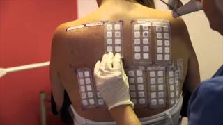 Skin Allergy Testing Using Patch Tests [upl. by Juanita106]