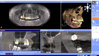 Galileos CBCT in Dentistry [upl. by Hannon]