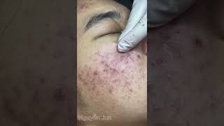 Acne skin care and treatment restore damaged skinđiềutrịmụn spa trending trend [upl. by Tisman]