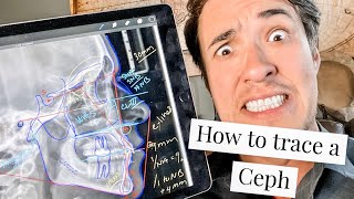 How to trace a Lateral Ceph in orthodontics [upl. by Mela]