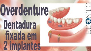 Overdenture prótese total fixa por dois implantes [upl. by Burkhart]