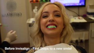 MY INVISALIGN TREATMENT EXPERIENCE  The Start of My Teeth Transformation [upl. by Brelje]