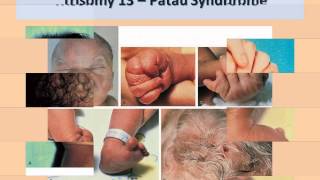 Approach to a Newborn with Dysmorphic FeaturesDr Prakash Manikoth FRCPCH [upl. by Samid]