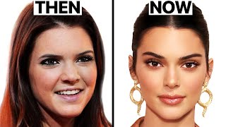 What Happened to Kendall Jenners Face  Plastic Surgery Analysis [upl. by Balfore]