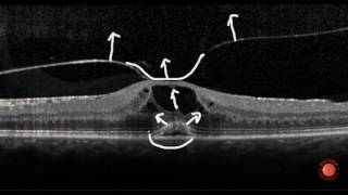 OCT Interpretation  Vitreous [upl. by Redep613]