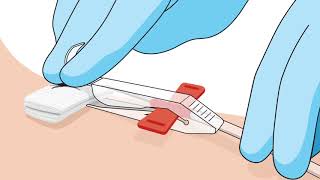 MasterGuard Apheresis Needle Removal Video [upl. by Niram]