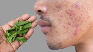 सिर्फ 3 बार में पिंपलफोड़ेफुंसी हमेशा के लिए ख़त्म  Pimples Treatment [upl. by Trstram73]