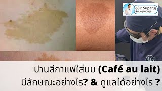 ปานสีกาแฟใส่นม Café au lait มีลักษณะอย่างไร amp ดูแลได้อย่างไร [upl. by Nagad]