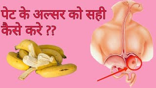 3 दिन में पेट के अल्सर को करें जड़ से ख़त्मquotPeptic Ulcer Treatment In Hindiquot [upl. by Ahsiek444]