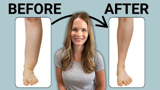 The Best Leg Lymphedema Treatment [upl. by Marozik]