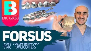 Braces Forsus for Overbite Overjet Correction [upl. by Russia]