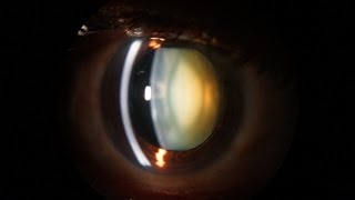 Slit Lamp examination of the anterior segment of the eye [upl. by Ane]