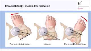 M Tannast In amp outtoeing a reliable diagnostic sign for femoral malversion Hip Symposium 2018 [upl. by Else]