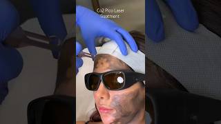 Co2 Pico Laser Treatment at CARA [upl. by Cestar598]