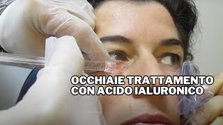 Occhiaie Trattamento con Acido Ialuronico [upl. by Ahsiakal]