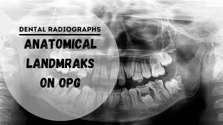 Dental panoramic radiographs  OPG  DPT Anatomical Landmarks [upl. by Kimmel]