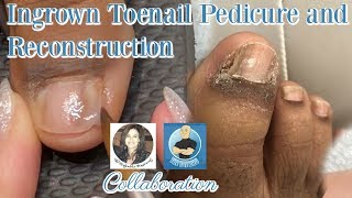 Pedicure with Toenail Reconstruction After Ingrown Toenail Removal with The Toe Bro [upl. by Tahp497]