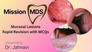 Mucosal Lesions Rapid Revision MCQ  Oral Medicine  Mission MDS 2024 [upl. by Rogerg]