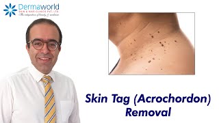 Skin Tag Acrochordon Removal  Dr Rohit Batra [upl. by Chaffin106]