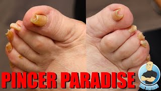 TRIMMING OF SUPER CURVED PINCER TOENAILS [upl. by Calandra]