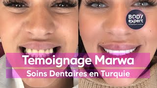 SOINS DENTAIRES  🦷 Témoignage 6 Implants et 24 Couronnes Emax  BODYEXPERT [upl. by Marline103]