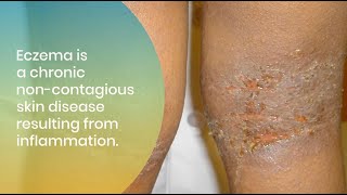 Treating and Managing Eczema in All Skin of Colors [upl. by Brace]