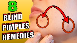 How To Get Rid Of A Blind Pimples HOME REMEDIES [upl. by Averyl]