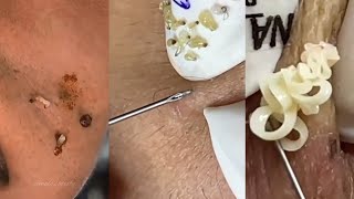 Ultimate Satisfying Pimple Pops Compilation  Blackhead amp Cyst Extraction Relaxation ASMR [upl. by Faxun872]