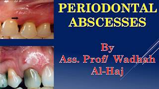 16 Periodontal diseases 6 Periodontal abscessesDr Wadhah Periodontology lectures دوضاح الحاج [upl. by Guibert]