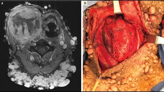 Maligner peripherer Nervenscheidentumor bei Neurofibromatose Typ 1 [upl. by Lamrert]