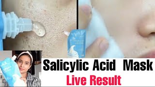 Salicylic Acid Ice Cream Mask Removeopen porse Acne  Pimples Black Heads  Honest Review  Demo [upl. by Faythe]