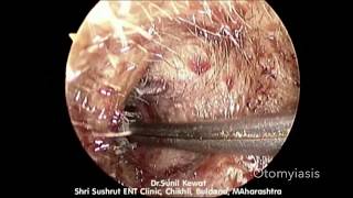 Otomyiasis  Maggots in Ear  Endoscopic Maggots Removal from ear [upl. by Usanis]