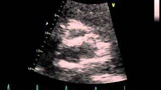 CALCIFICATION RIGHT CORONARY AORTIC CUSP [upl. by Alon844]